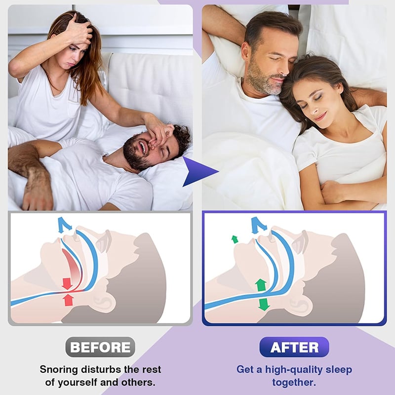✨2025 New Release -49% Off - Anti Snoring Devices Effective to Relieve Snoring 👃