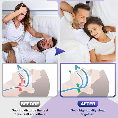 ✨2025 New Release -49% Off - Anti Snoring Devices Effective to Relieve Snoring 👃